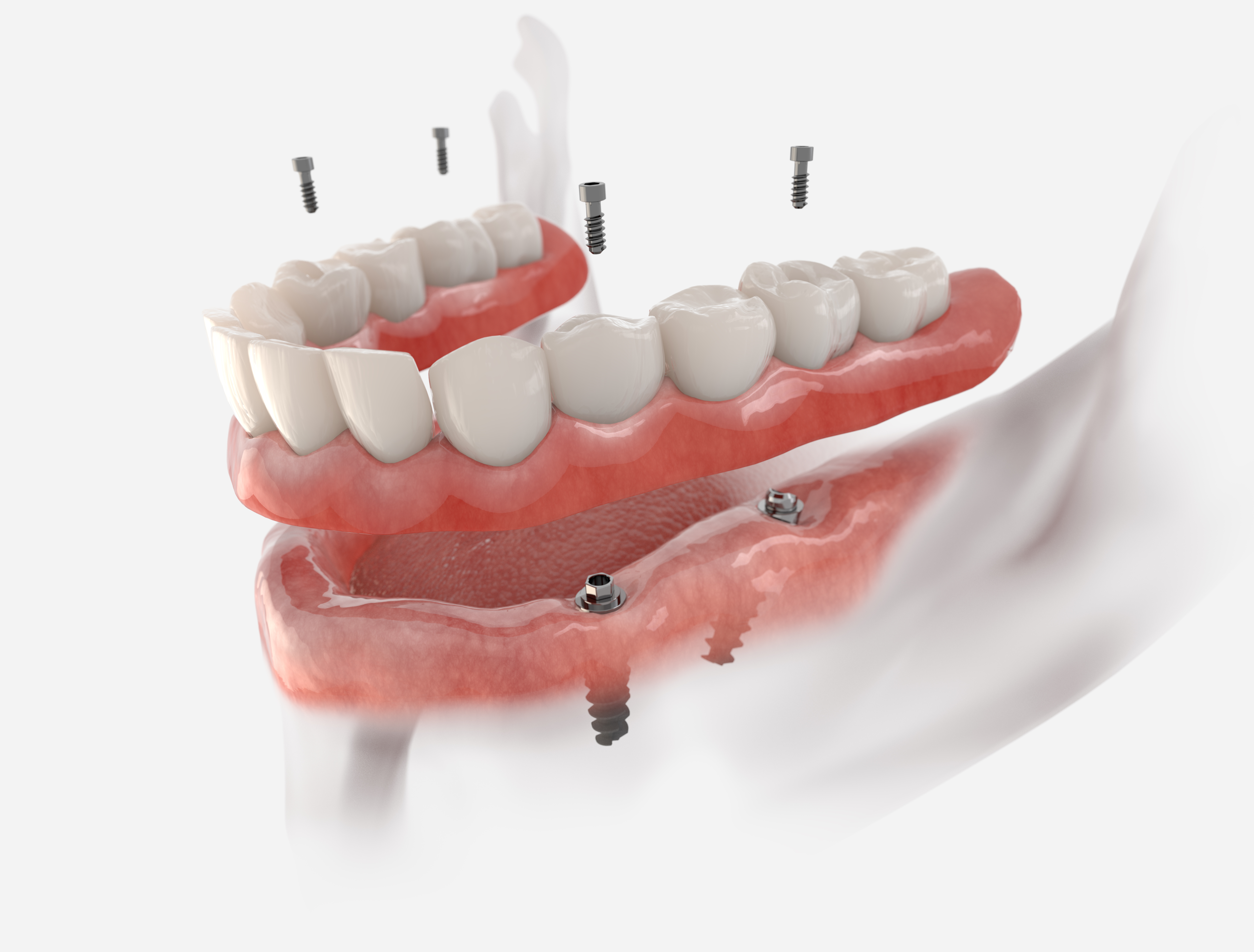 Full-mouth dental implants