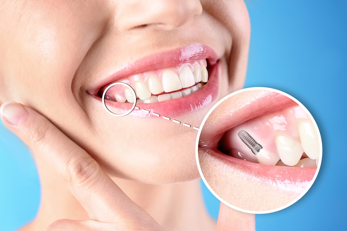 Get Your Full Smile in Just One Day Visit